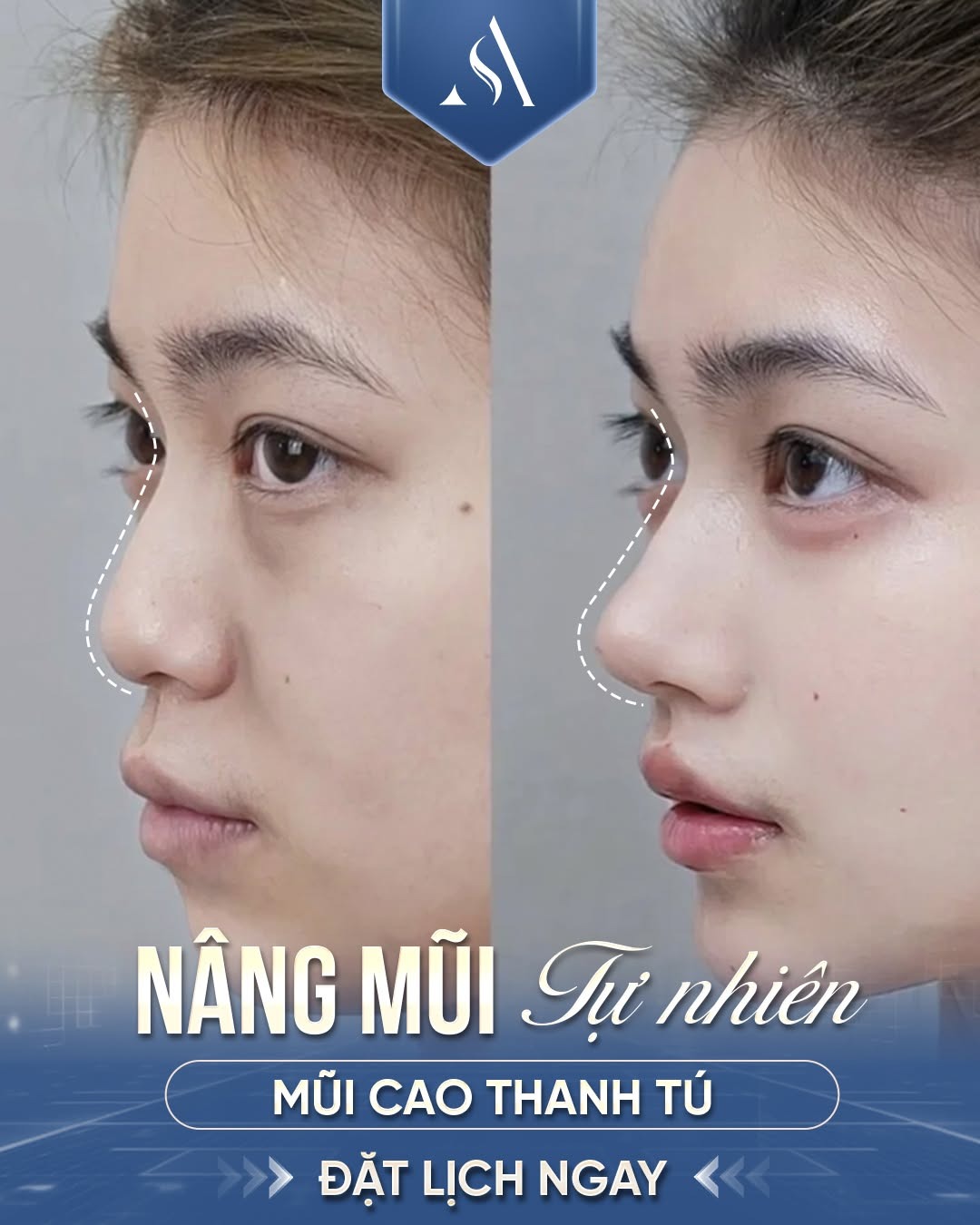 Sau nâng mũi bị nghẹt có sao không? Cách khắc phục an toàn tại nhà Nâng mũi tự nhiên an toàn tại Thẩm mỹ Dr. Xuân Quân