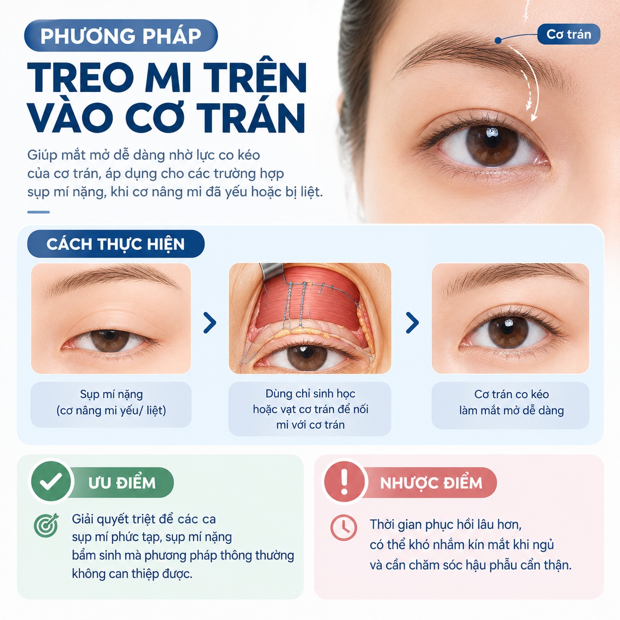 Phương pháp treo mi trên vào cơ trán