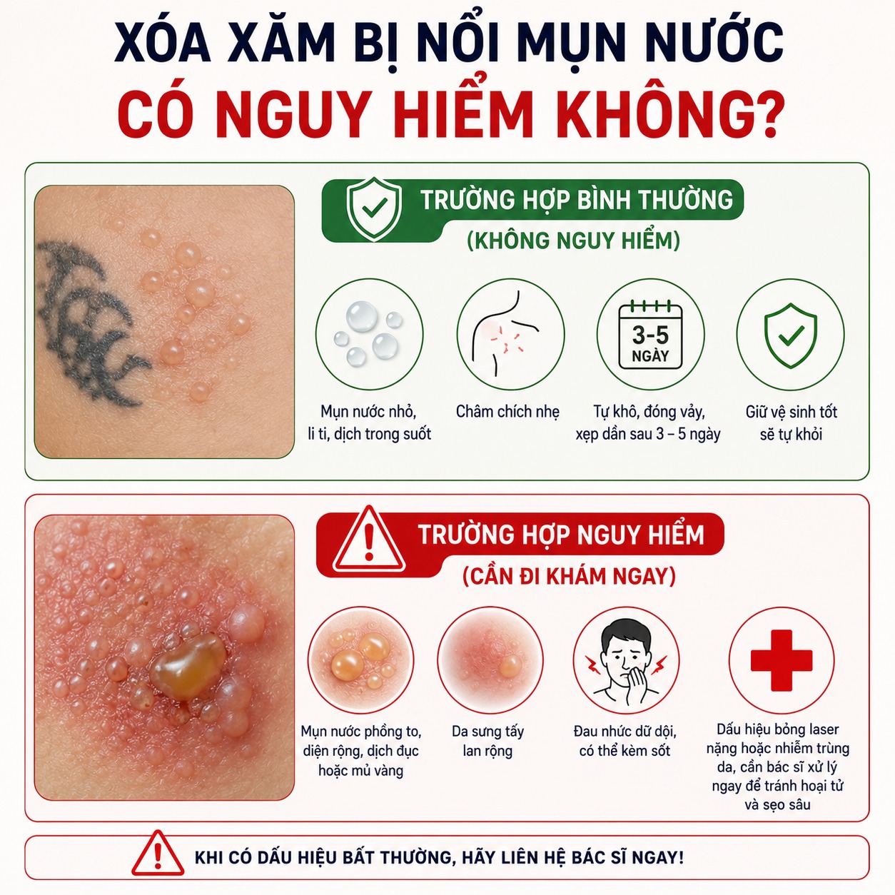 Blisters Appear After Tattoo Removal: How to Treat Them Safely Xóa xăm bị nổi mụn nước có nguy hiểm không?