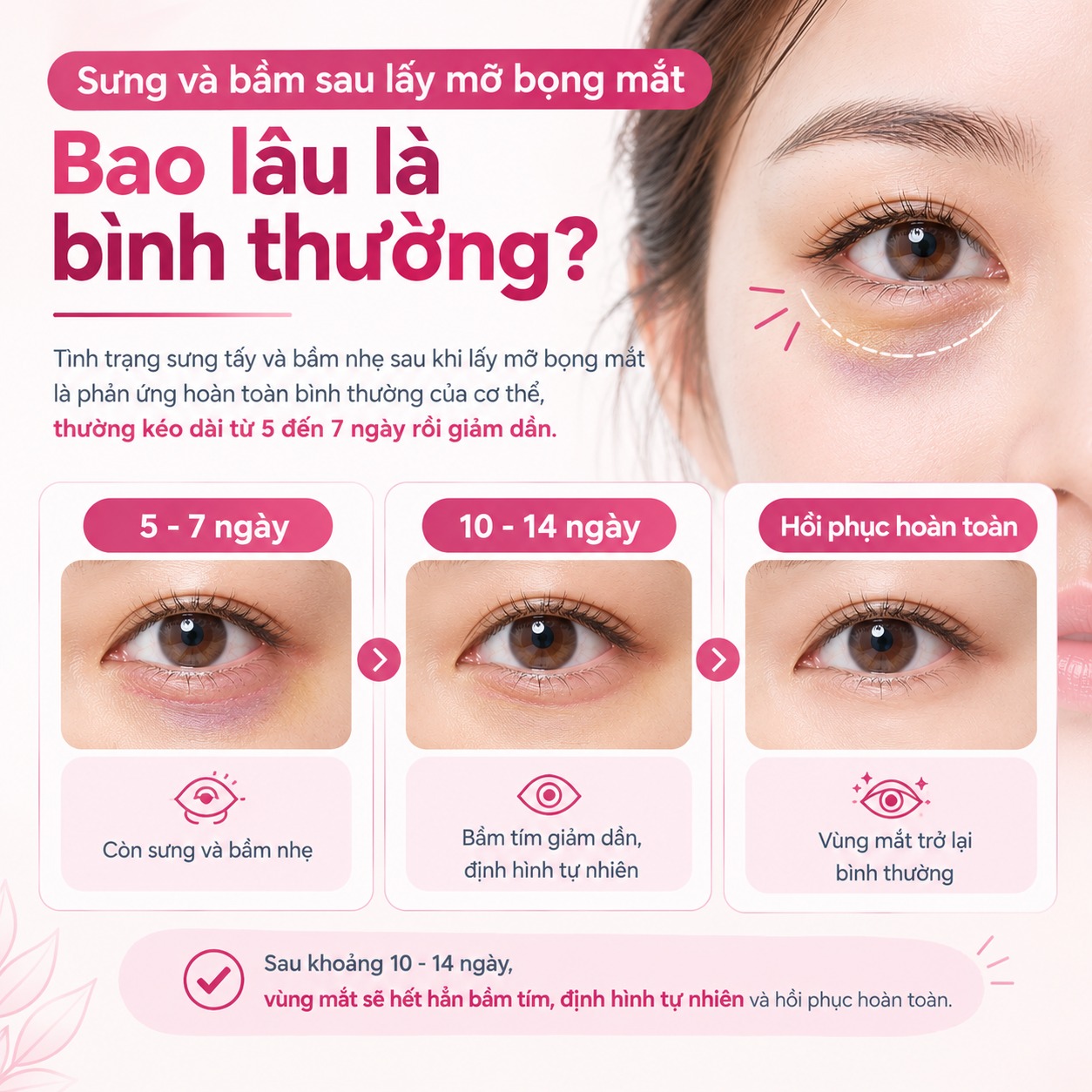Hướng dẫn cách chăm sóc sau khi lấy mỡ bọng mắt giúp mắt nhanh lành, không sẹo Sưng và bầm sau lấy mỡ bọng mắt bao lâu là bình thường?