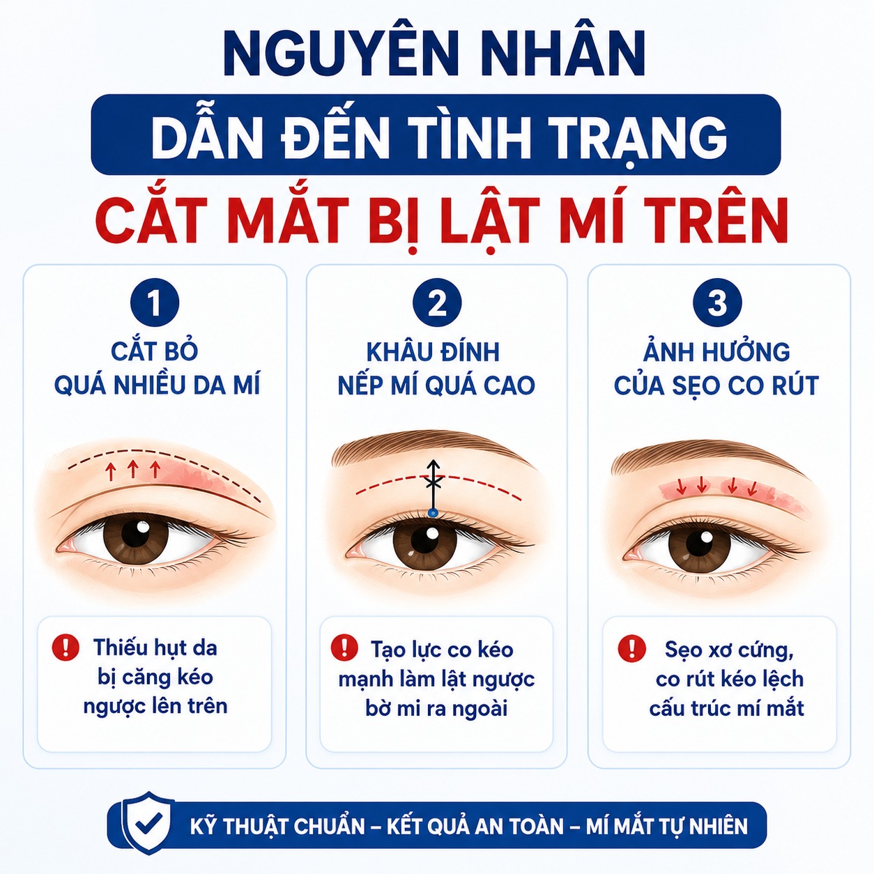 Cắt mắt bị lật mí trên do đâu? Có khắc phục được không? Nguyên nhân dẫn đến tình trạng cắt mắt bị lật mí trên