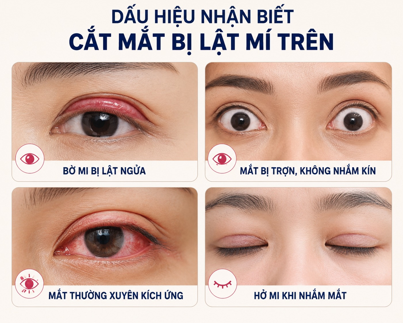 Dấu hiệu nhận biết cắt mắt bị lật mí trên