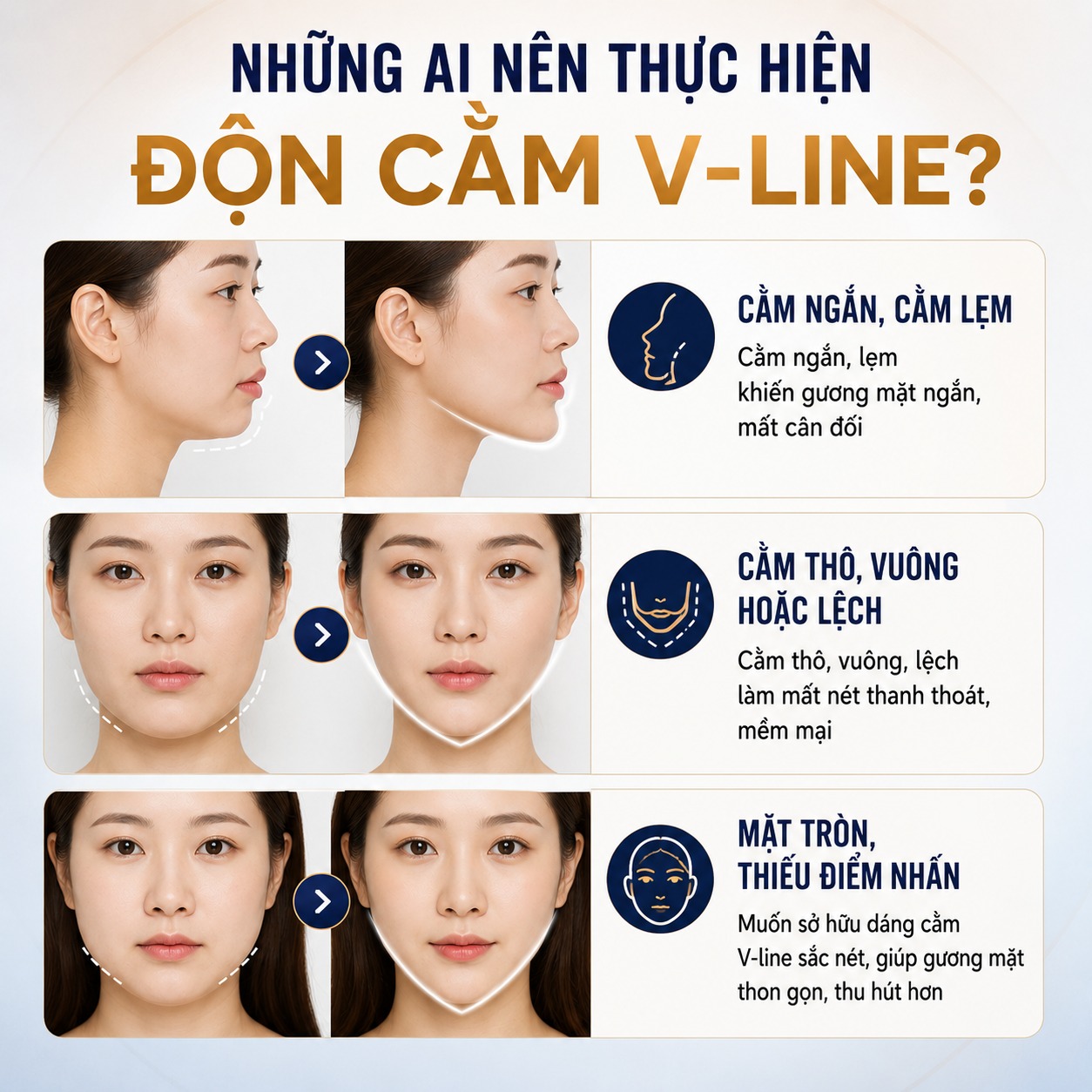 Ai nên thực hiện độn cằm Vline?