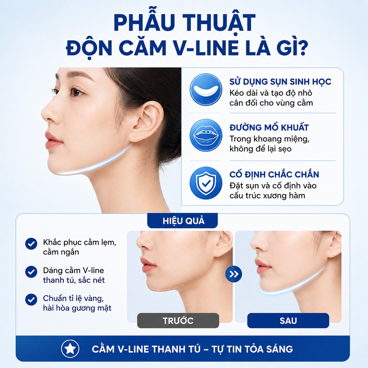 Phẫu thuật độn cằm Vline là gì?