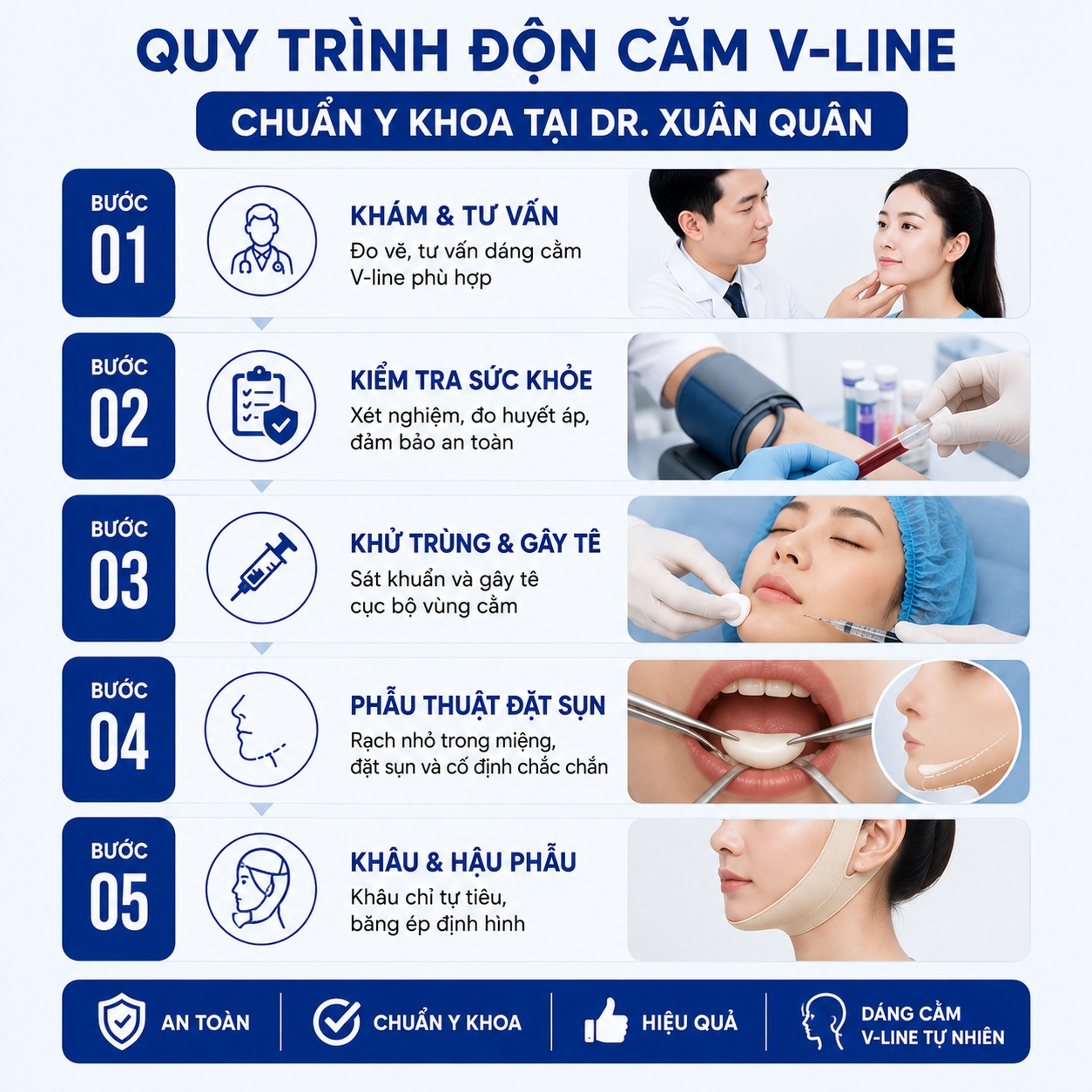 Quy trình độn cằm Vline chuẩn y khoa tại Thẩm mỹ Dr Xuân Quân