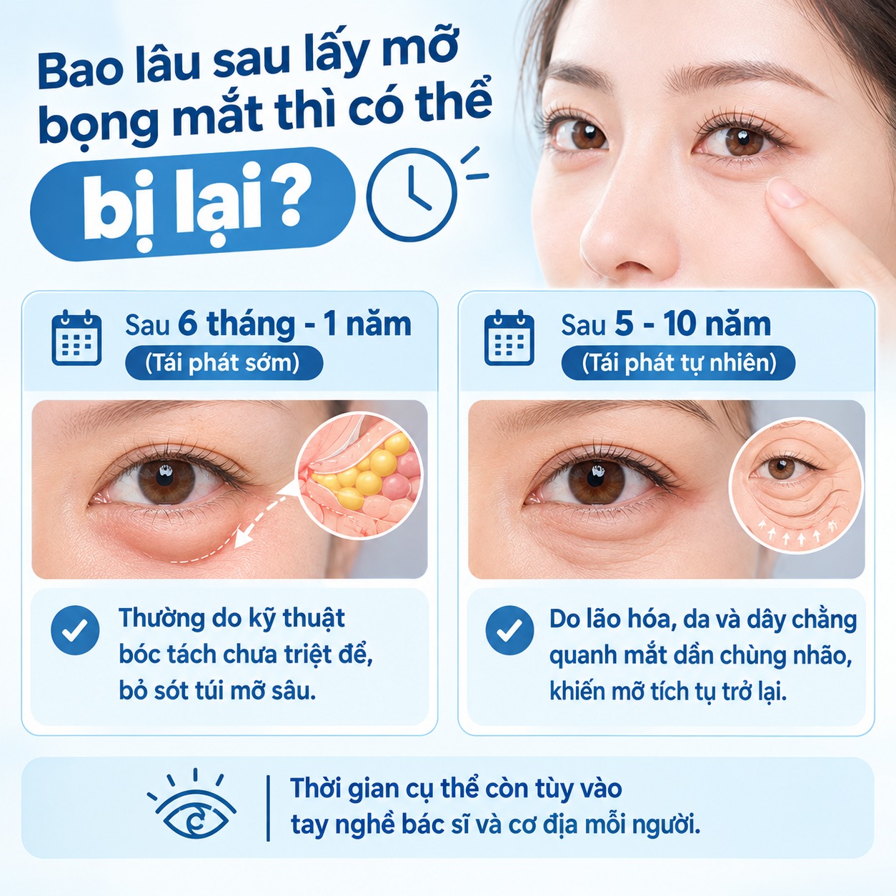 Lấy mỡ bọng mắt có bị lại không? Giải đáp từ chuyên gia Bao lâu sau lấy mỡ bọng mắt thì có thể bị lại?