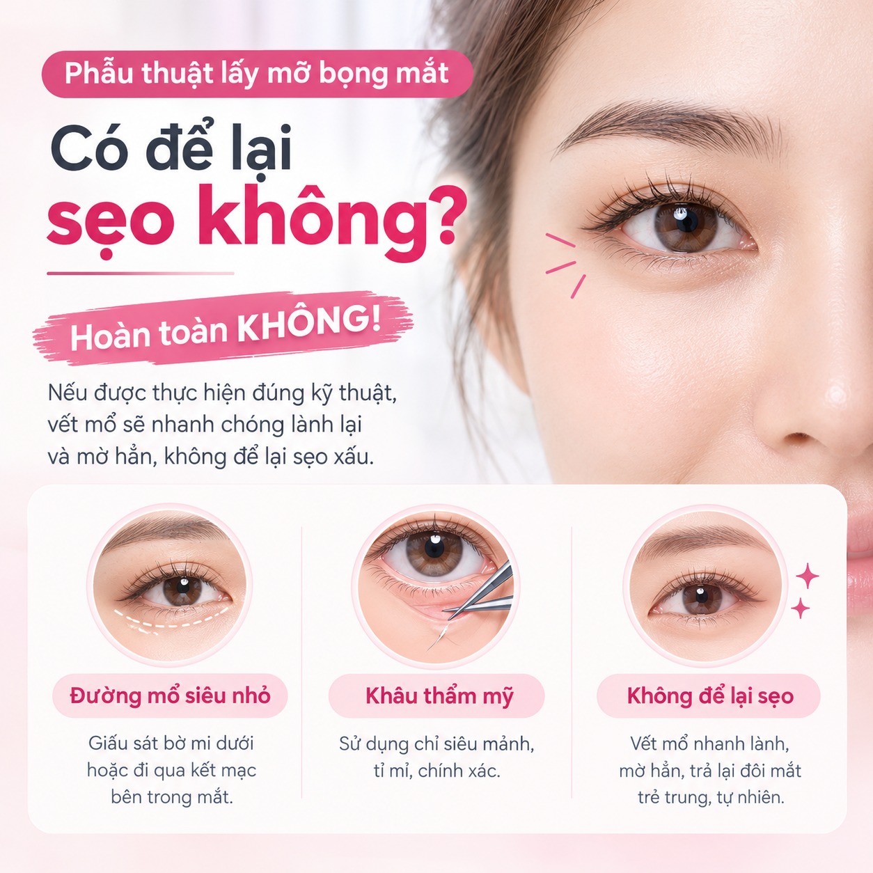 Phẫu thuật lấy mỡ bọng mắt có để lại sẹo không?