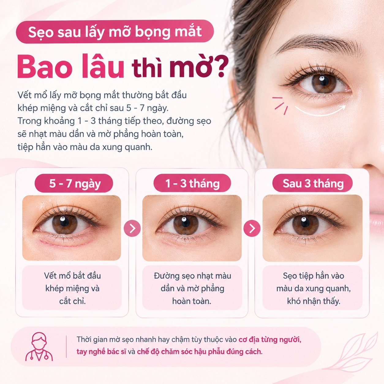 Sẹo sau lấy mỡ bọng mắt bao lâu thì mờ?