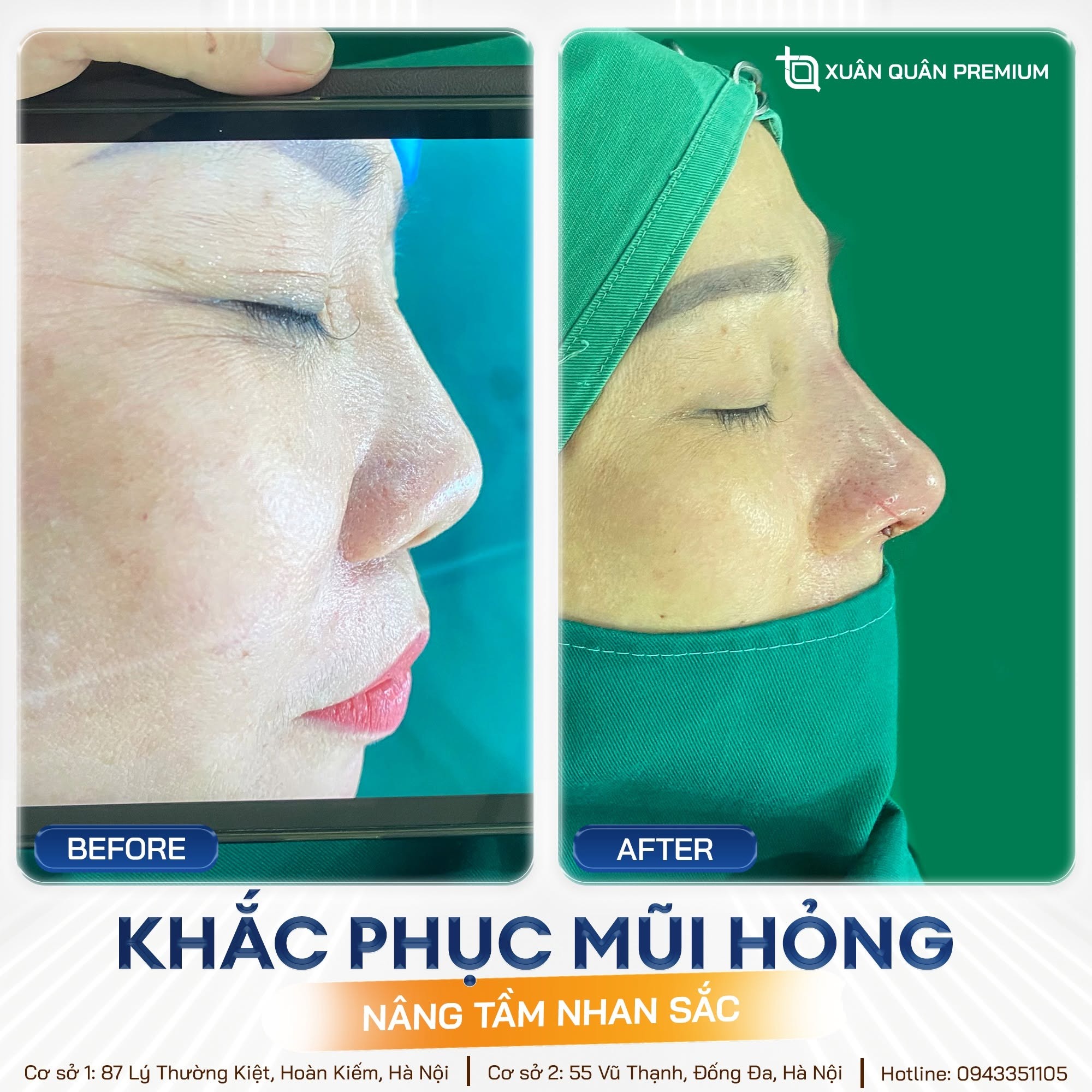 Nâng mũi cấu trúc có bị tụt sụn không? Nguyên nhân và cách phòng ngừa Nâng mũi tự nhiên - Chỉnh sửa mũi hỏng tại Thẩm mỹ Dr. Xuân Quân