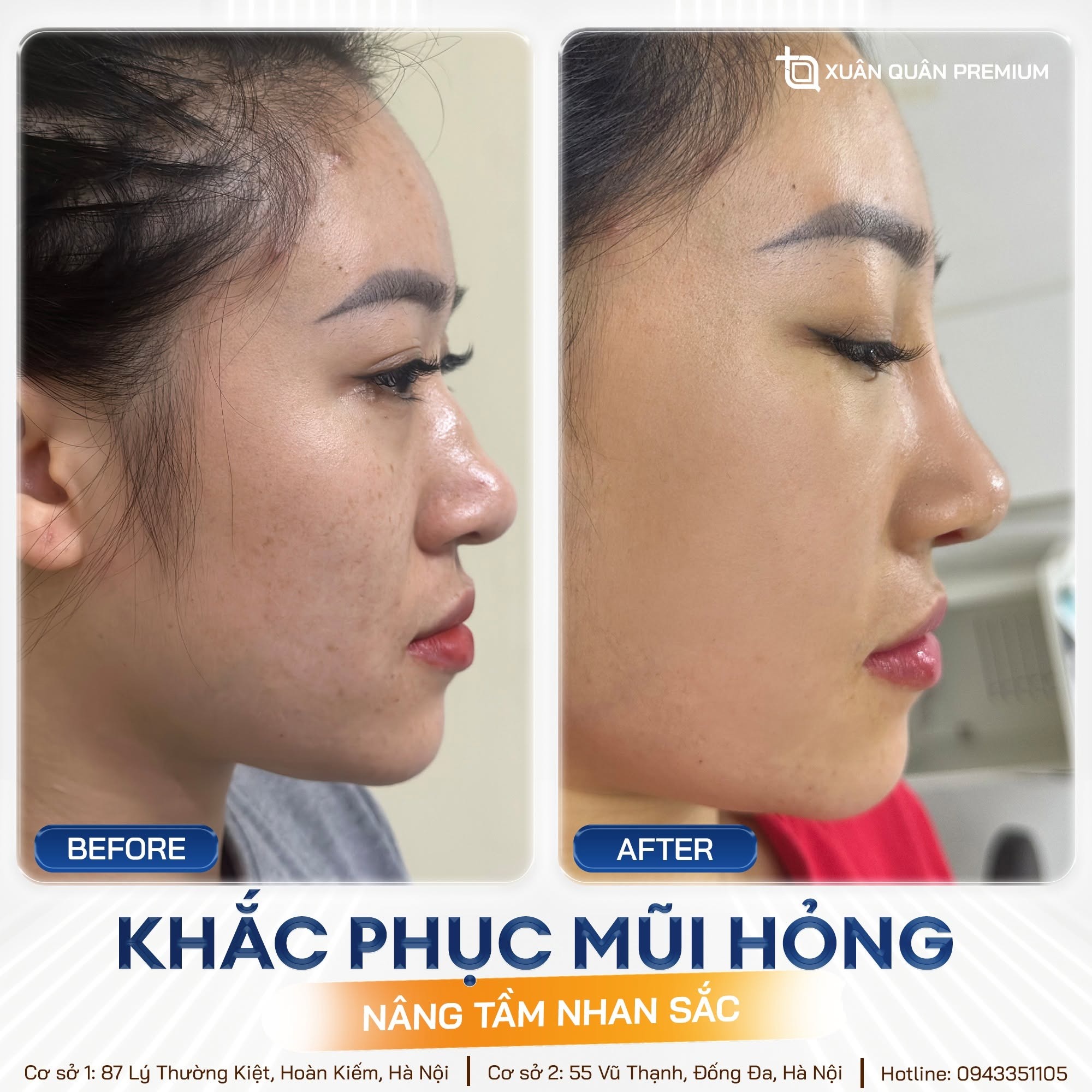 Nâng mũi cấu trúc có bị tụt sụn không? Nguyên nhân và cách phòng ngừa Giải pháp an toàn tại Thẩm mỹ Dr. Xuân Quân