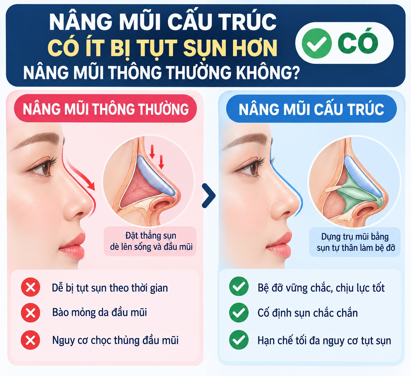 Nâng mũi cấu trúc có bị tụt sụn không? Nguyên nhân và cách phòng ngừa Nâng mũi cấu trúc có phải ít bị tụt sụn hơn nâng mũi thông thường không?
