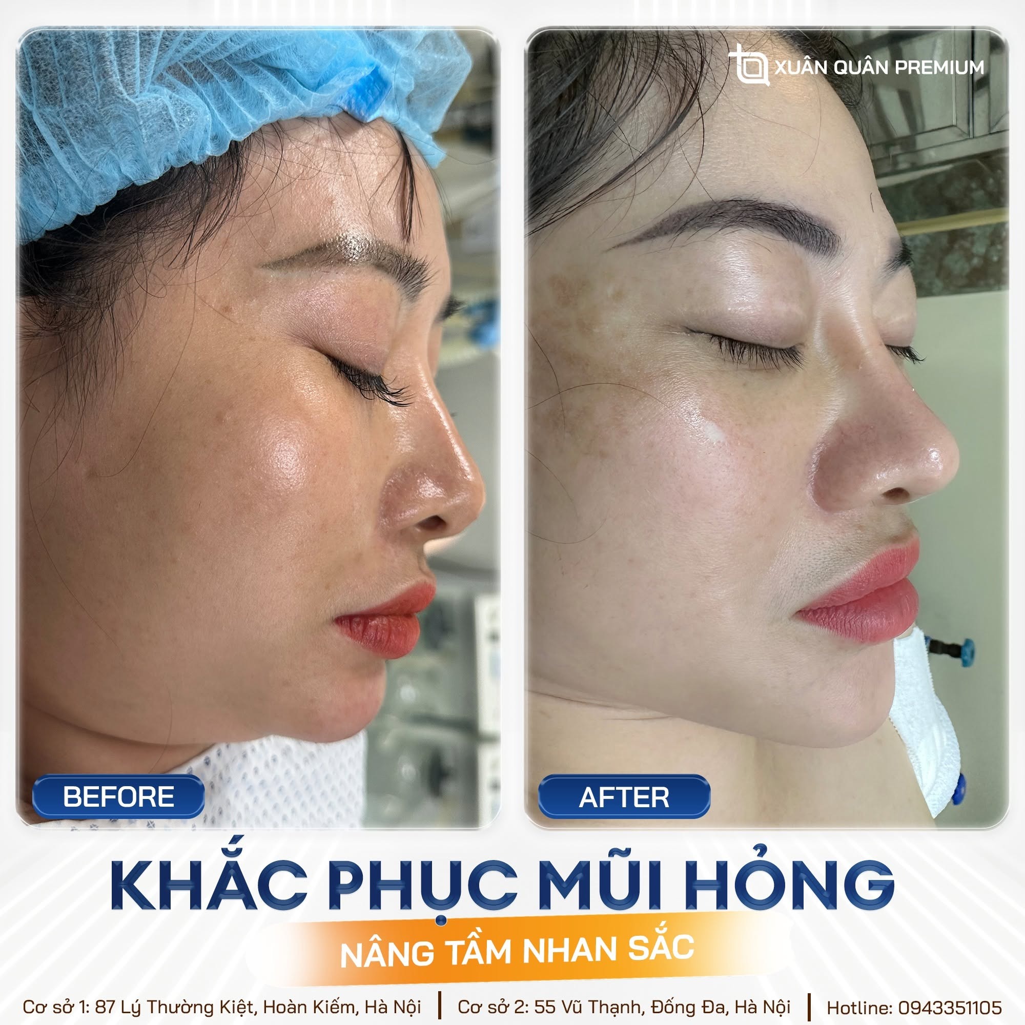Nâng mũi cấu trúc có bị tụt sụn không? Nguyên nhân và cách phòng ngừa Khắc phục mũi hỏng tại Thẩm mỹ Dr. Xuân Quân